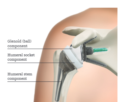 Reverse Shoulder